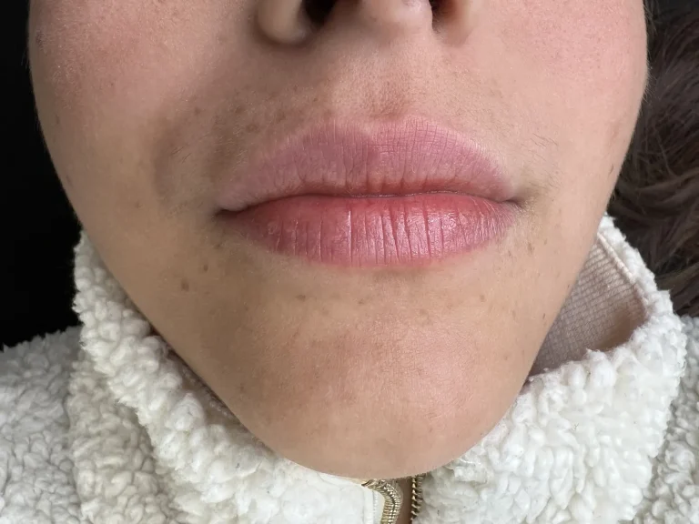 Lip Neutralization